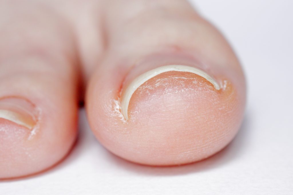 Basic Foot and Toenail Care in Lethbridge
